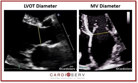 3 Steps to Quantifying MR via Stroke Volume Method! Cardioserv