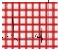 What is Ventricular Trigeminy? - Definition, ECG, Symptoms, Causes ...