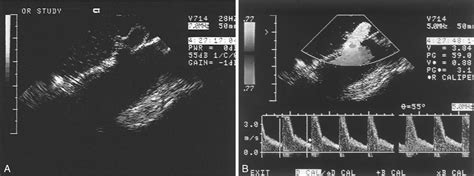 Ischemia-Induced Muscle Myonecrosis, Myoglobinuria, and Secondary Kidney Failure | Thoracic Key