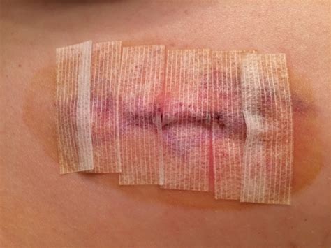 Yellow Beads and Me: Lipoma Removal Surgery (with Pictures)