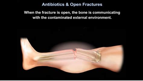 Antibiotics and Open Fractures — OrthopaedicPrinciples.com