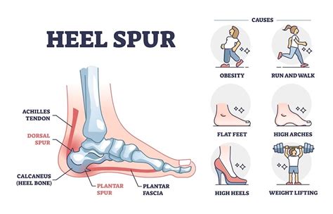 Expert Dorsal Heel Spur Surgery Solutions