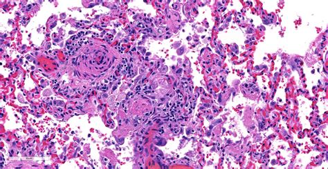 Portal Hypertension Histology