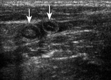 US image showing a transverse section of a normal appendix twice due to... | Download Scientific ...