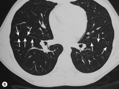 The thorax | Radiology Key