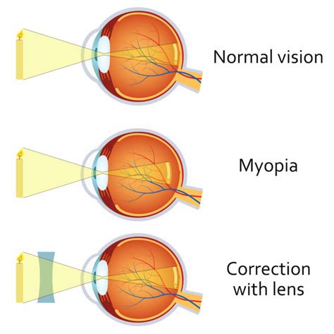 Myopia Management Portland | Nearsightedness Portland, ME | Rosemont