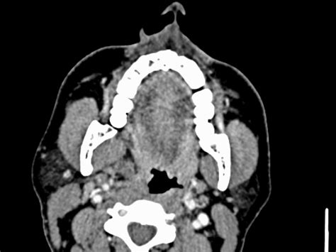 Pleomorphic adenoma CT - wikidoc