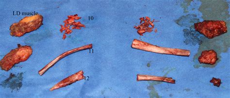 Transformations In Focus: Rib Removal Before After