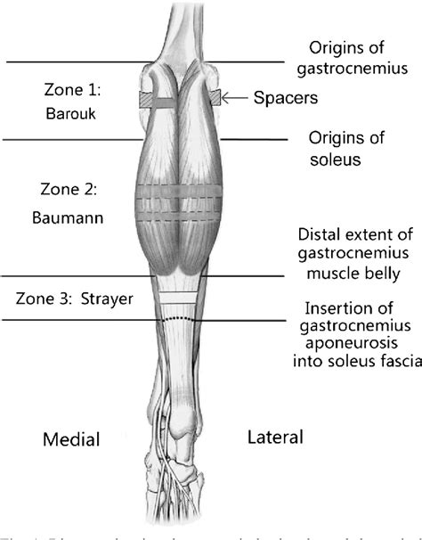 Comparison of the efficacy of three isolated gastrocnemius recession ...