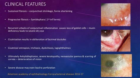 Ocular cicatricial pemphigoid, Stevens-Johnson Syndrome, Toxic Epider…