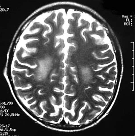 Infarction: Corona Radiata Infarct