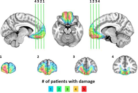 Figure 1 from Behavioral/Cognitive Ventromedial Prefrontal Cortex Damage Is Associated with ...