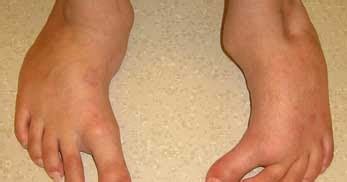 Metatarsus adductus - Images, stretching exercises, Shoes, Clubfoot - Health Care Tips and ...