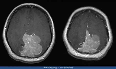 Cortical blindness | MedLink Neurology