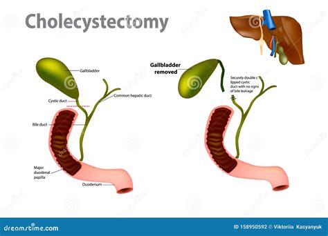 Gallbladder Removal Surgery Stock Vector - Illustration of operation ...