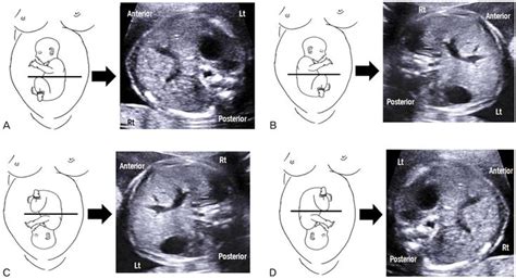 Abdominal Circumference with different fetal lies | Ultrasound, Ultrasound sonography, Medical ...