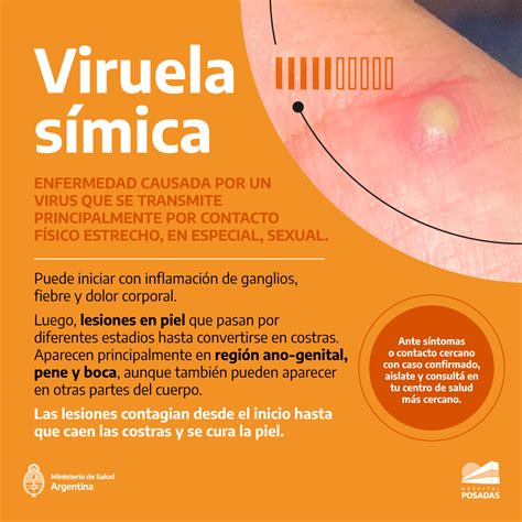 Viruela símica: síntomas y prevención | Argentina.gob.ar