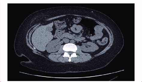 CT scan showing the defect of a Spigelian hernia about 3 cm in... | Download Scientific Diagram