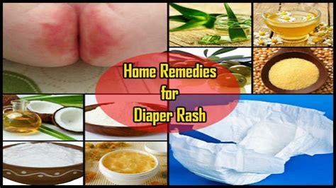 Home Remedies for Diaper Rash: Aapka Baccha Rahe Swasth