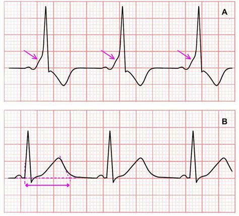 (A) Wolff-Parkinson-White (WPW) syndrome (pink arrow: Delta wave). (B)... | Download Scientific ...