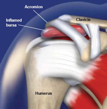 Subacromial Bursitis | Central Coast Orthopedic Medical Group