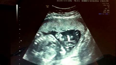 24 weeks pregnant ultrasound! It's a boy :) - YouTube