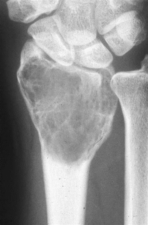 Local recurrence of giant cell tumor of bone after intralesional ...