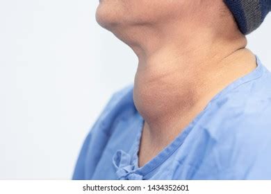 Goiter Stock Photos and Pictures - 6,621 Images | Shutterstock