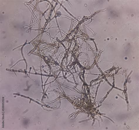 Microscopic fungi Malassezia furfur, showing yeast cells and hyphae. They are associated with ...