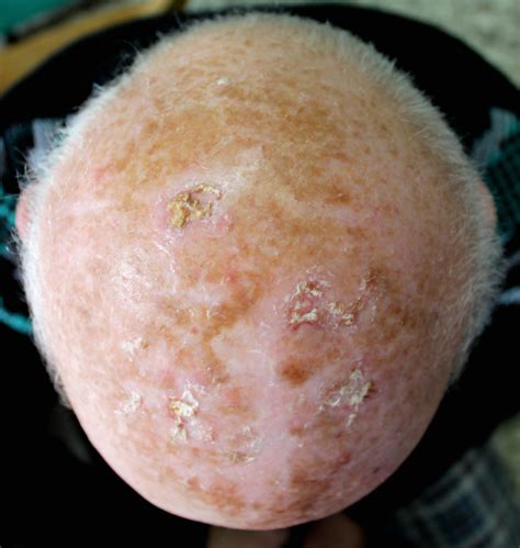 Actinic Keratosis Appearance vs. Squamous Cell Carcinoma » Scary Symptoms