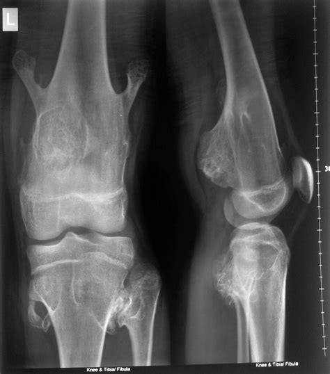 Radiodiagnosis - Imaging is Amazing-Interesting cases: Diaphyseal Aclasis-Hereditary multiple ...