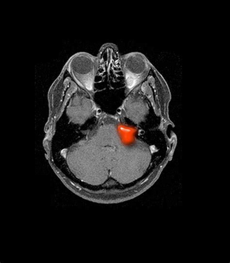 Acoustic Neuroma | Neurosurgery and Endovascular Associates