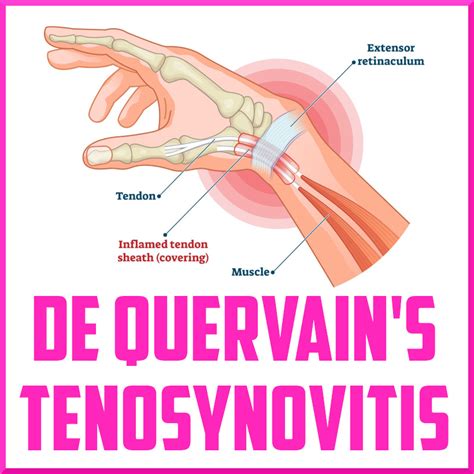 De Quervain Tendinopathy