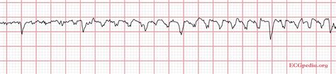 EKG artifacts - wikidoc