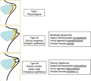 Sulcus vocalis: a review | SpringerLink