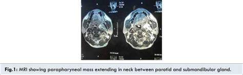 Plunging Lipoma Neck: A Rarity