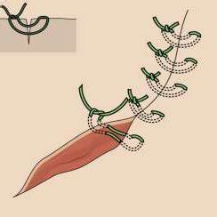 -Vertical mattress suture technique. | Download Scientific Diagram