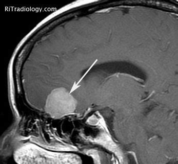 RiT radiology: Olfactory Groove Meningioma