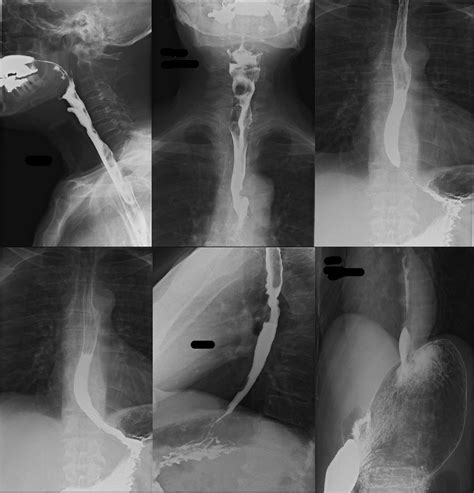 A Radiography Blog: Radiographer Performed Barium Swallow | Barium swallow, Radiographer ...