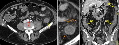 Ischaemic colitis - CT - Radiology at St. Vincent's University Hospital