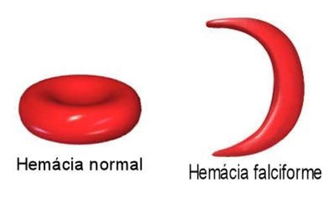 Os indivíduos heterozigóticos apresentam tanto hemácias e hemoglobinas ...