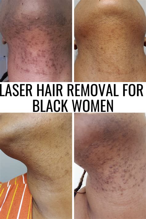 Laser Hair Removal | Laser hair removal face, Laser hair removal, Hair removal