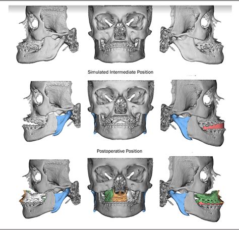 Figure 4 from Improving Esthetic and Functional Outcomes of Severe Habsburg Jaw Using Modified ...