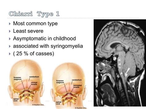 Syringomyelia ( Morvan syndrome) Electrodiagnosis | PPT