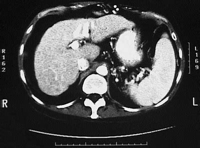 Hepatic Pathology