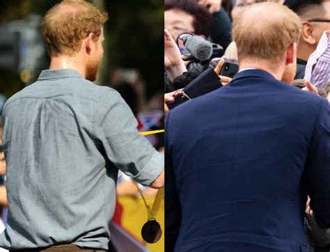 Prince Harry's bald patch has doubled this year