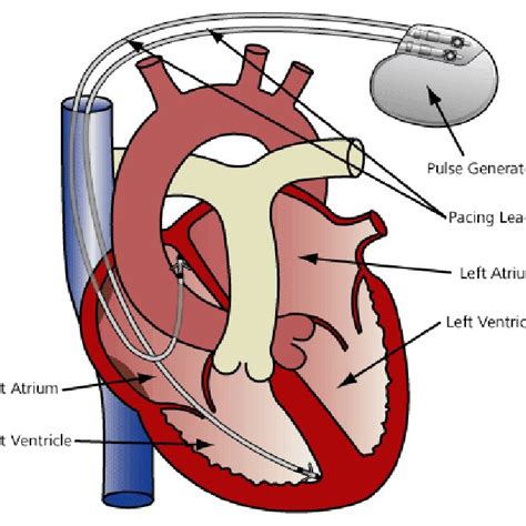 Photograph of the Biotronik Lumax 300 HF-T pacemaker with the | Download Scientific Diagram