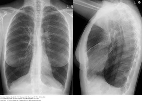 Chronic Obstructive Pulmonary Disease | Basicmedical Key