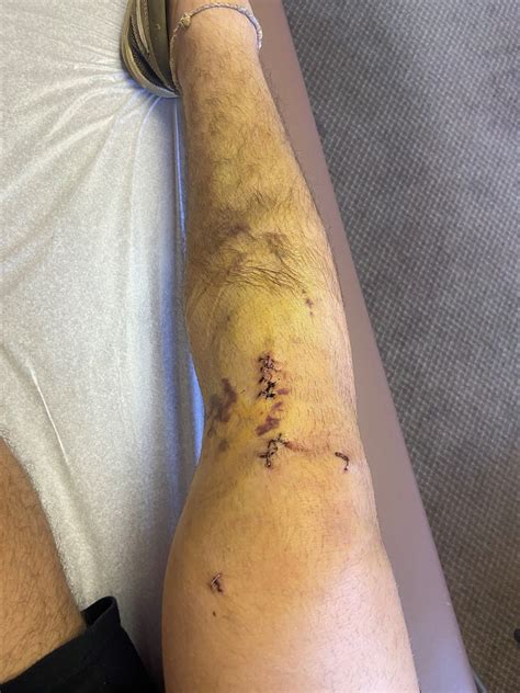 The Infamous ACL Tear: Part 2, The Road to Recovery | by Tyler Citrin ...