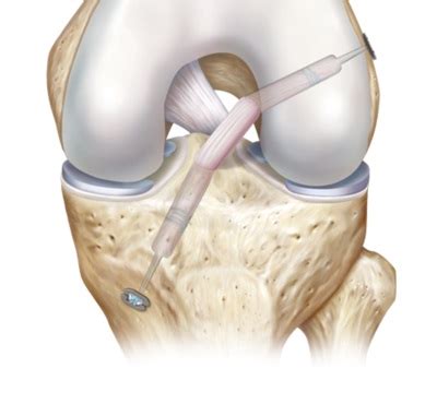 ACL and PCL | Knee Repair or Reconstructive Surgery | Free consultation